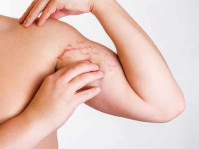 Stretch Marks Home Remedies Stretch Marks Home Remedies
