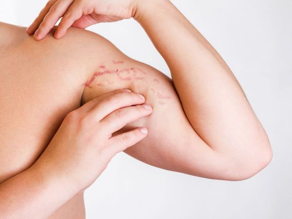 Stretch Marks Home Remedies