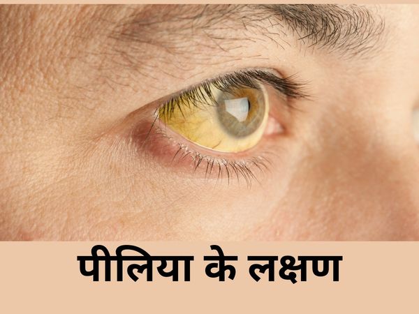 Symptoms of Jaundice
