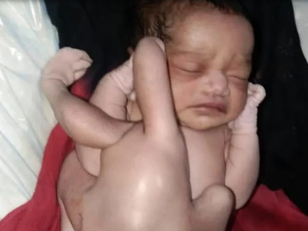 Child Born With Four Hands And Four Legs in Uttar Pradesh
