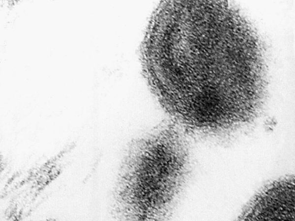 anthrax virus, corona virus, yekaterinburg city of russia, effect of pneumonia