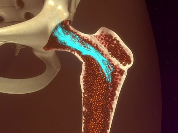 what is bone marrow cancer 