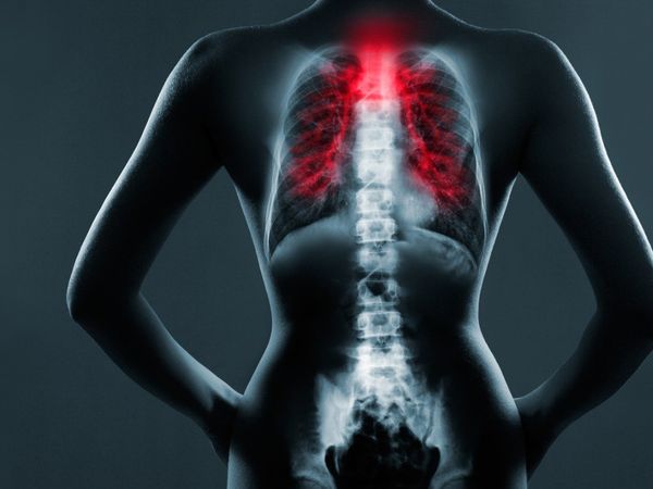 Bone death in hindi,bone death cause, bone death symptoms, bone death treatment, What is Bone death,बोन डेथ क्या है, कोरोना और बोन डेथ, bone death covid,bone death news in Hindi,bone death covid, bone death symptoms, bone death treatment