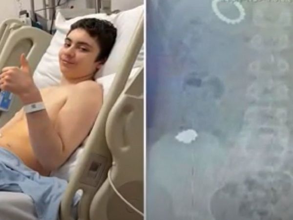 जरा देखूं तो कॉपर पेट से चिपकता है या नहीं! यही सोच 54 मैग्‍नेटिक बॉल निगल गया बच्चा, फिर 6 घंटे चला ऑपरेशन