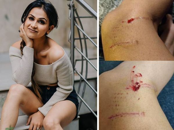 Mujhse shaadi karoge Fame TV Actress aanchal Khurana attacked by 3 stray dogs