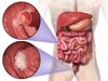 Colorectal cancer: कोलोरेक्टल कैंसर और उपचार के बारें में यहां है पूरी जानकारी