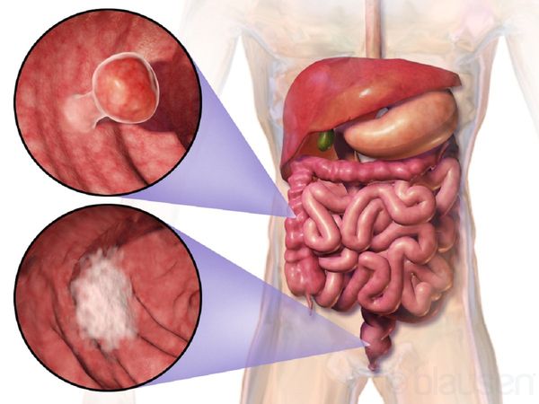 Colorectal cancer: कोलोरेक्टल कैंसर और उपचार के बारें में यहां है पूरी जानकारी
