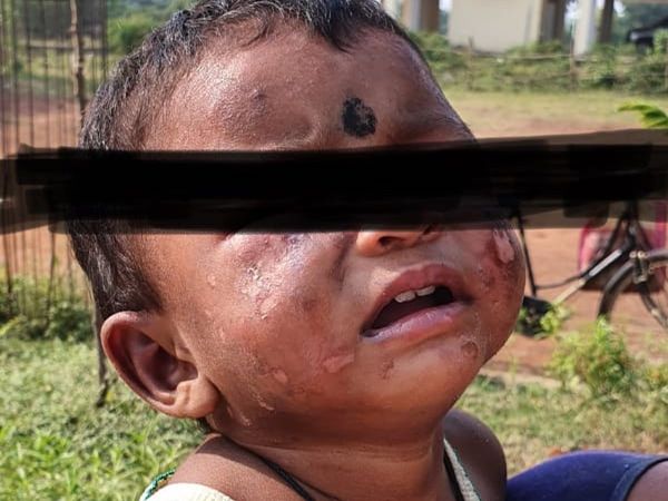 कॉन्स्टेबल की दरिंदगी! 'पापा' नहीं बोलने पर डेढ़ साल की मासूम को सिगरेट से दागा