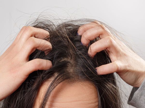 Try these hair care tips for drandruff
