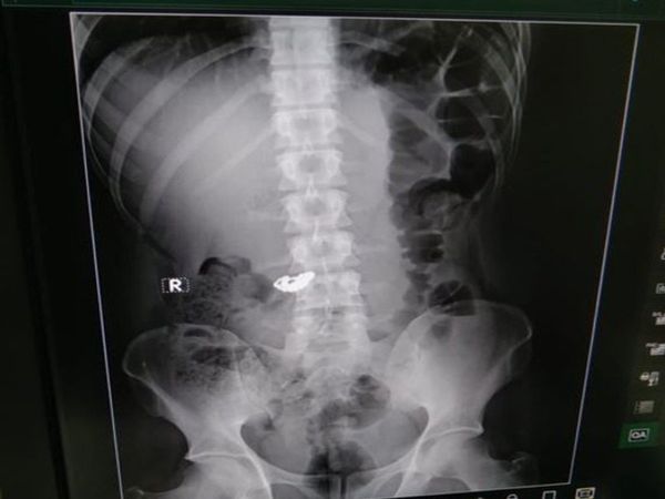 OMG recover the gold chain swallowed by accused police and doctors fed him bananas to make him poop gold