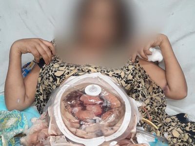 पति ने पार की क्रूरता की इंतहां, पत्नी को पिलाया एसिड, बुरी तरह झुलसी महिला पति ने पार की क्रूरता की इंतहां, पत्नी को पिलाया एसिड, बुरी तरह झुलसी महिला
