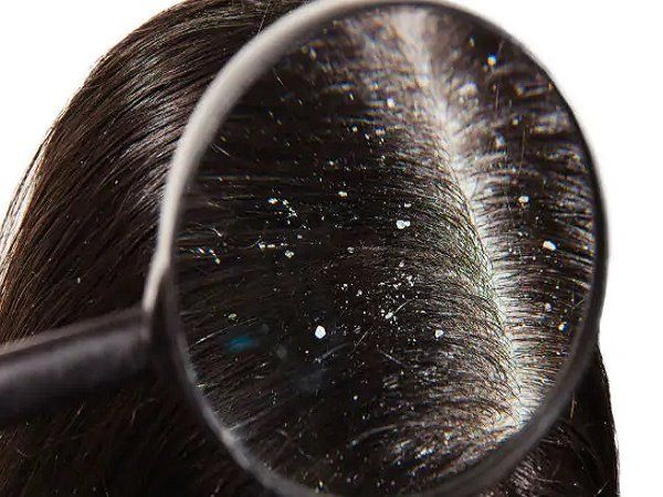 how to get rid of dandruff 