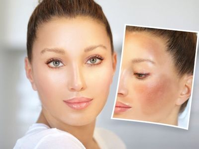 Home Remedies for black spots, Home Remedies for hyperpigmentation 