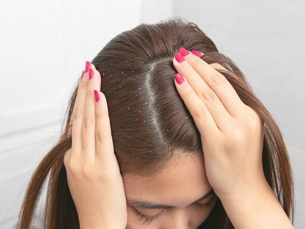 Dandruff Hair care tips