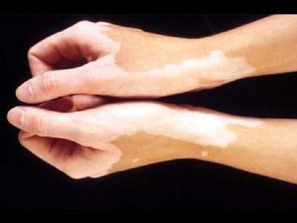 leucoderma home remedy