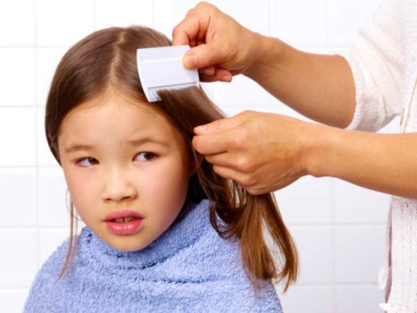 How to Kill and Get Rid of Head Lice at home, How to get rid of head lice permanently, How to Kill and Get Rid of Head Lice, How do you get rid of lice overnight, How to Kill and Get Rid of Head Lice 2O21, How do you get rid of lice super fast,जुंए को हटा