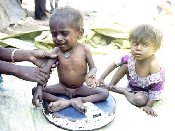 malnourished children in India
