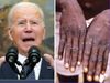 US on war with monkeypox, how ready is India?