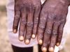  Ministry of Health and Family Welfare releases guidelines for Monkeypox disease