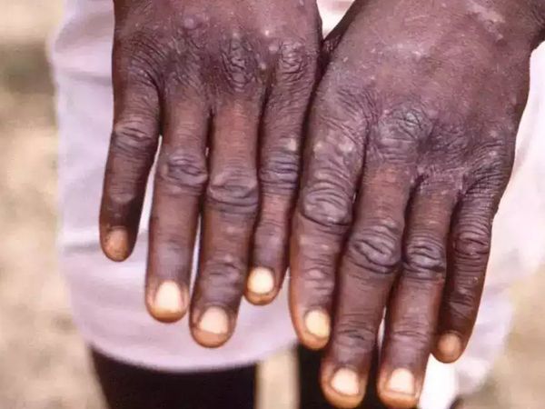  Ministry of Health and Family Welfare releases guidelines for Monkeypox disease