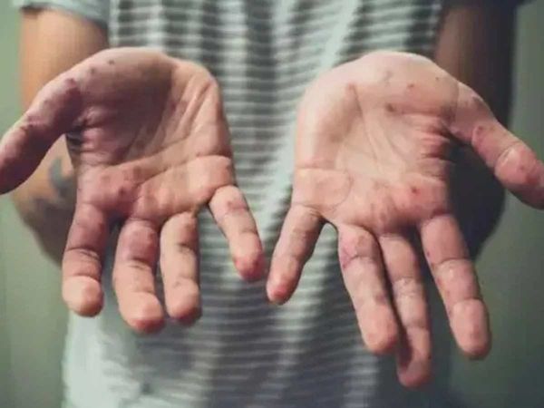 WHO Southeast Asia on alert after first case of monkeypox reported in India