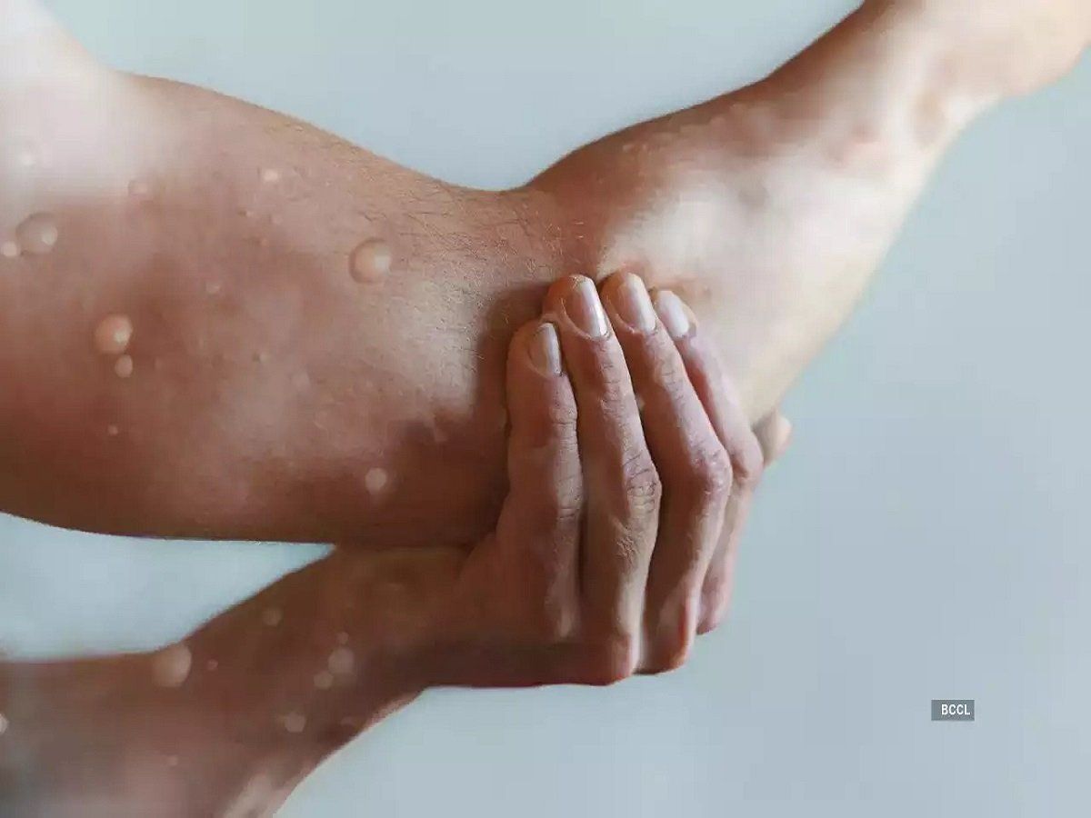 Monkeypox: आईसीएमआर सीरो सर्वे पर कर रहा है विचार, संपर्क में आए बिना लक्षण वालों पर खास ध्यान