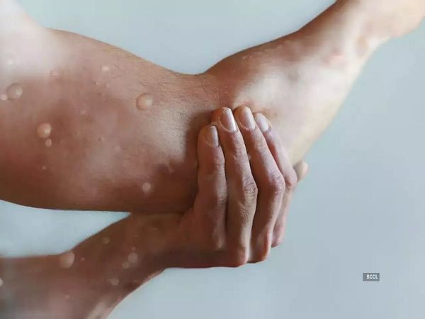 Monkey pox, sero survey, ICMR, asymptomatic patients