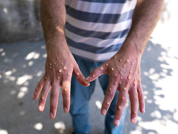 Do not take monkeypox lightly, it may cause neuro and mental illness, study revealed