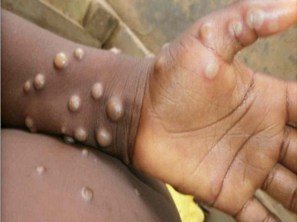 Nigerian woman tests positive for monkeypox in Delhi total number of cases in the country is 13