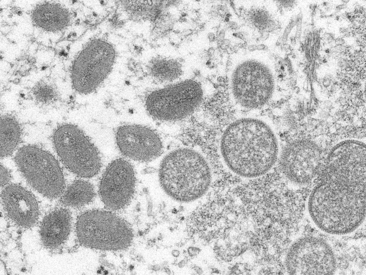Monkeypox की अब दिल्ली में दस्तक, संक्रमित की विदेश यात्रा की नहीं कोई हिस्ट्री; देश में फिलहाल चौथा केस