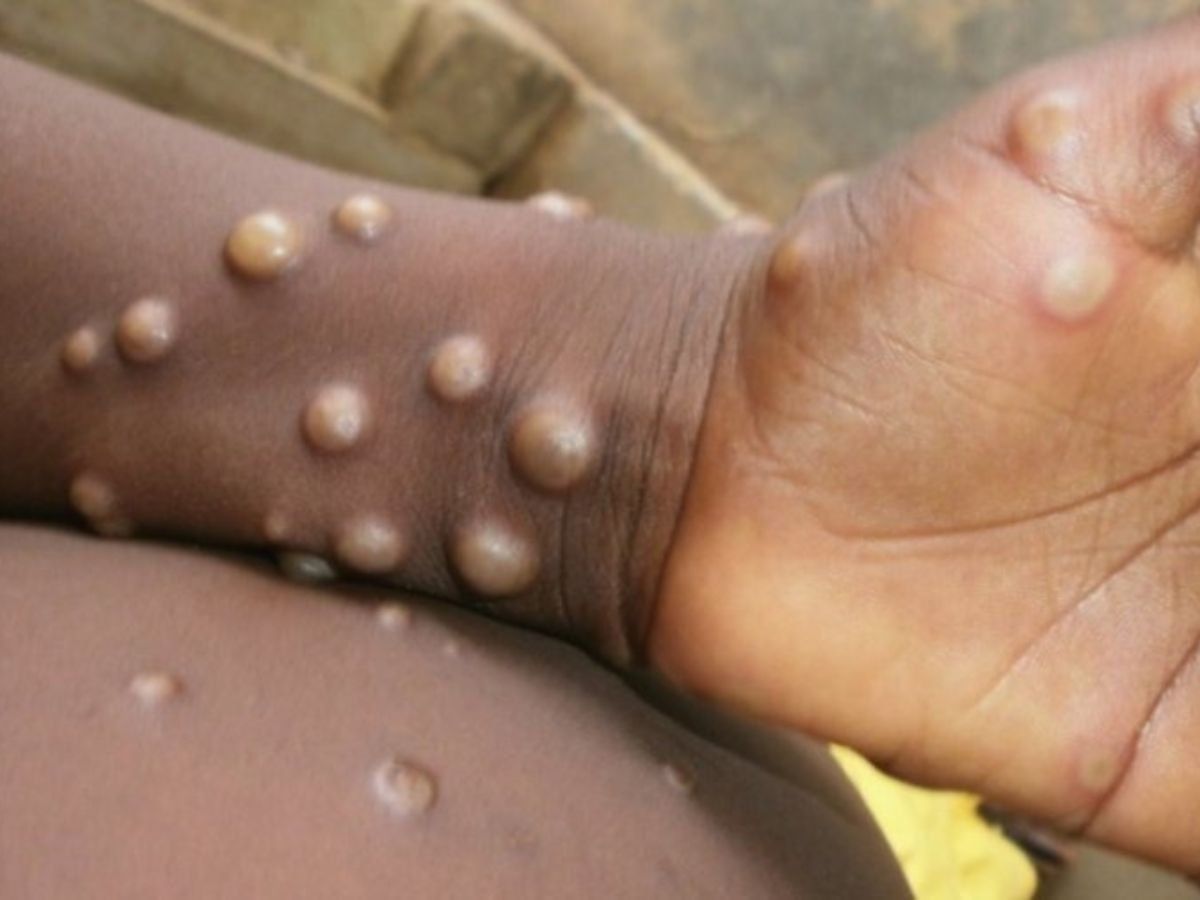 COVID के बीच Monkeypox बना आफत! जानें- कैसे इस वायरस से खुद को रख सकते हैं सुरक्षित?