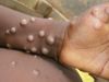 monkeypox, coronavirus, india