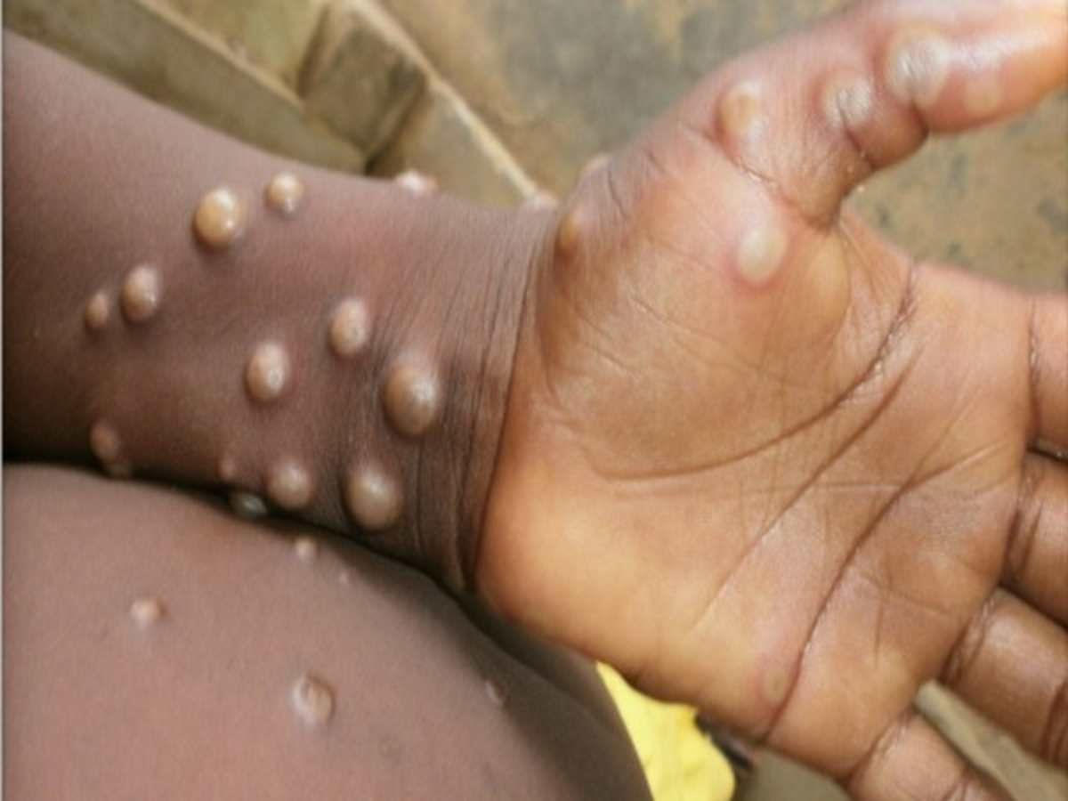 Monkeypox: आंध्र प्रदेश के गुंटूर में 8 साल के बच्चे में मिले मंकीपॉक्स के लक्षण, अस्पताल में कराया गया भर्ती