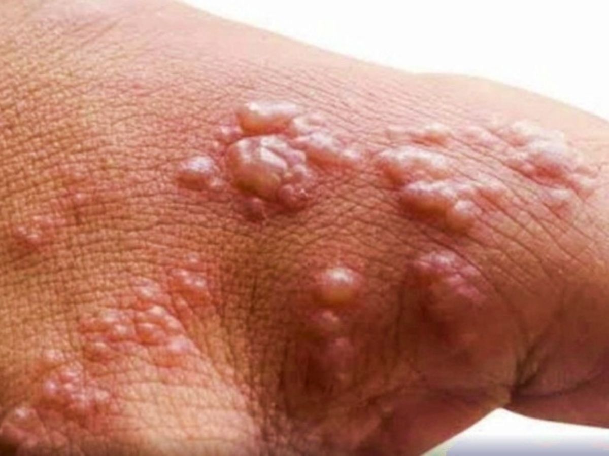 Monkeypox vs Chickenpox: दोनों के सामान्य लक्षणों से पनपा भ्रम, समझें- डॉक्टर्स ने क्या बताया