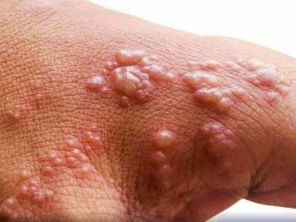 monkeypox, chickenpox, india