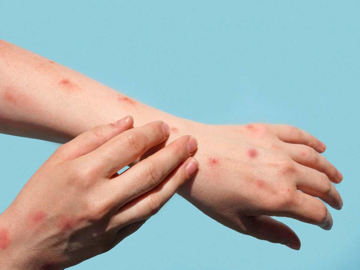 Monkeypox: भारत में मंकीपॉक्स से पहली मौत! UAE में ही केरल के शख्स की रिपोर्ट आई थी पॉजिटिव