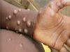 WHO warns Monkeypox may cause more deaths 