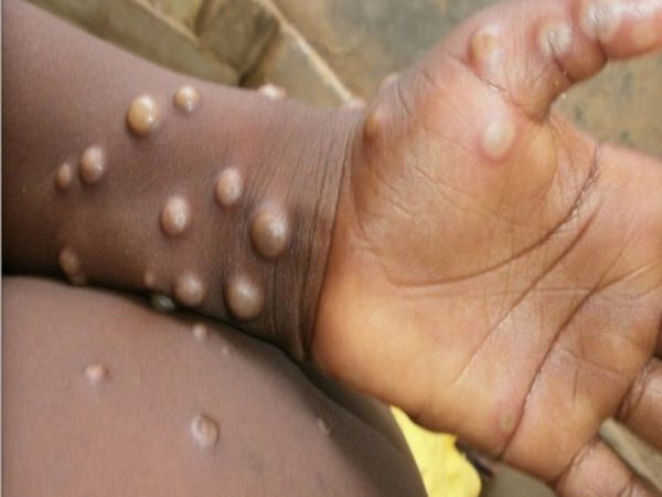 WHO warns Monkeypox may cause more deaths 