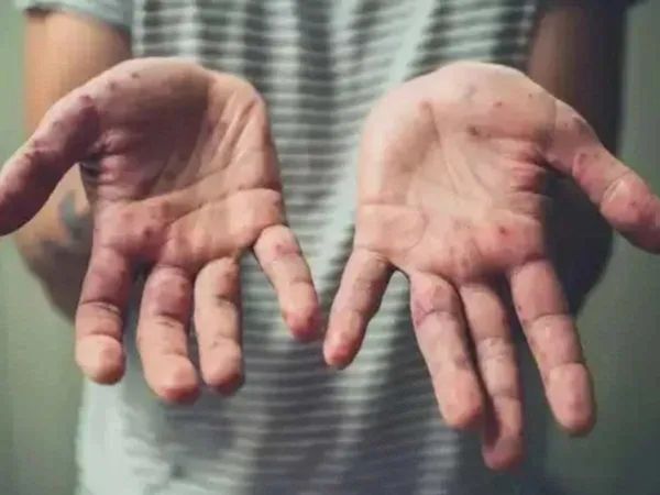 INDIA MONKEY POX CASE AND UPDATE