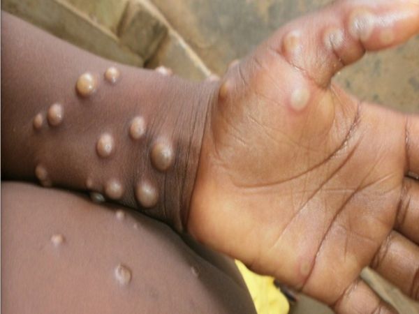monkeypox in Agra