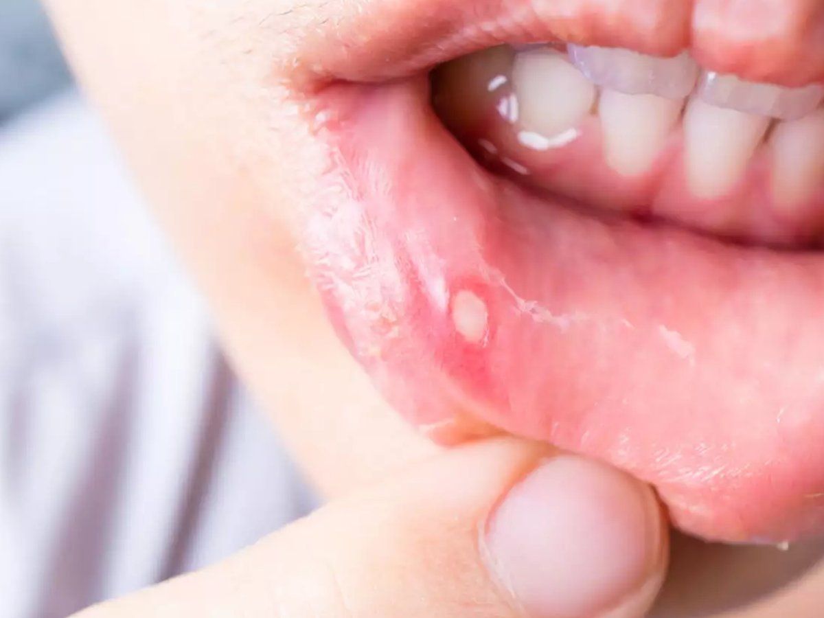 Mouth ulcers home remedies, Mouth ulcers cure, how to treat mouth
