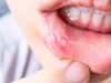 Mouth ulcers home remedies, Mouth ulcers cure, how to treat mouth ulcers, home remedies to cure mouth ulcers, mouth ulcer gel, मुंह के छाले, मुंह के छालों को ठीक कैसे करें, मुंह के छालों को ठीक कैसे किया जा सकता है