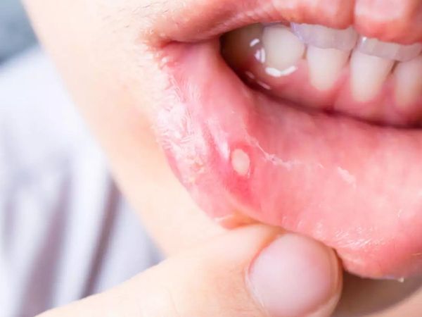 Mouth ulcers home remedies, Mouth ulcers cure, how to treat mouth ulcers, home remedies to cure mouth ulcers, mouth ulcer gel, मुंह के छाले, मुंह के छालों को ठीक कैसे करें, मुंह के छालों को ठीक कैसे किया जा सकता है