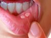 mouth ulcer and home remedy