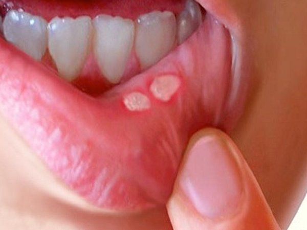 mouth ulcer and home remedy