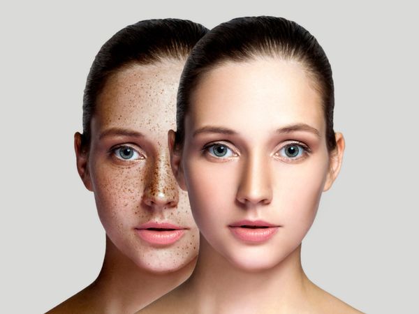 How to get rid of pimples