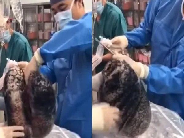 smoking affected lungs