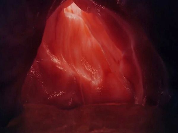 OMG: लड़की के पेट से निकला दो फुटबॉल के बराबर निकला ट्यूमर