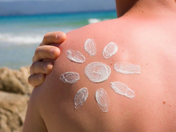 sunburn home remedy