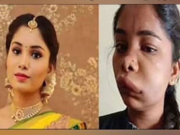 Swathi Sathish Kannada actress face swollen after root canal Surgery -